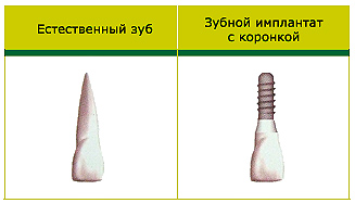 имплантация зубов имплантация зубов